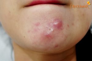 Mụn viêm ở cằm do đâu? 7 lời khuyên cho người bị mụn viêm ở cằm