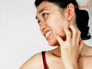 Mụn viêm ngứa DỮ DỘI phải làm thế nào?