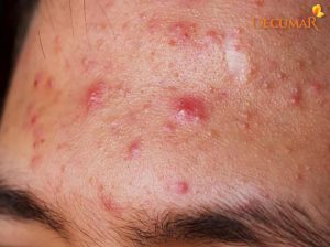 Làm sao hết mụn bọc? Điều trị mụn bọc cách nào hiệu quả nhất?