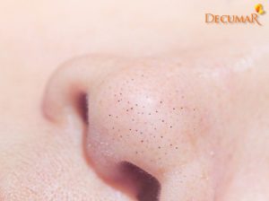 Có những loại mụn không viêm nào? Cách điều trị ra sao?