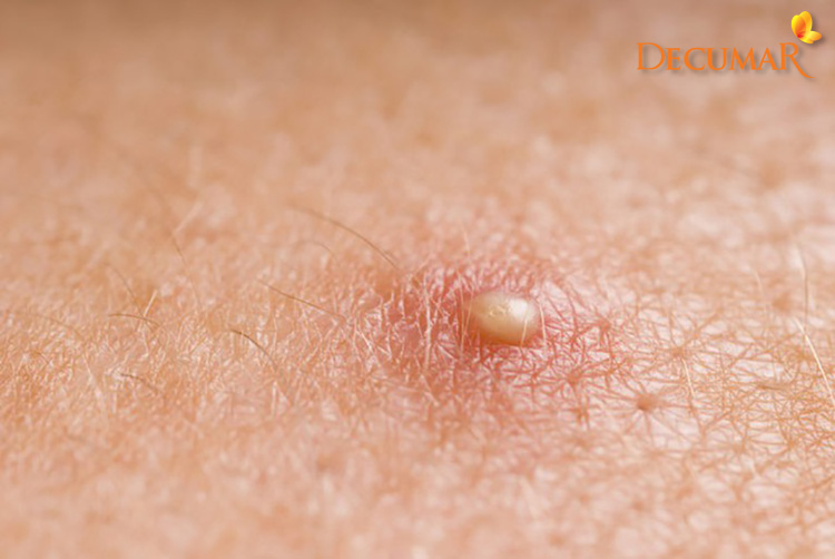 Mụn ẩn mặc dù là loại mụn không viêm nhưng lại nằm sâu dưới da và rất khó điều trị