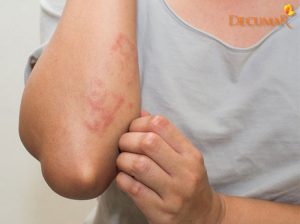 Mụn viêm da cơ địa là gì? Cách điều trị mụn viêm da cơ địa