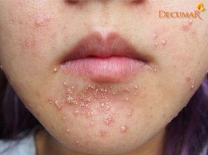 Điều trị và phòng tránh mụn viêm da dị ứng đơn giản với 9 bước