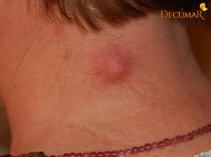Xử lý thế nào khi gặp phải tình trạng mụn viêm không đầu?