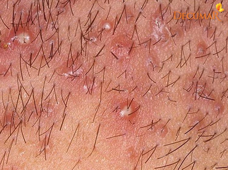 Mụn viêm nang lông khiến bạn khó chịu và thiếu tự tin Mụn viêm nang lông
