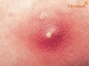 Mụn viêm đầu trắng là gì? Mụn viêm đầu trắng có nguy hiểm không?