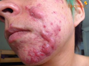 Nặn mụn bị viêm – SAI LẦM khiến tình trạng trầm trọng hơn