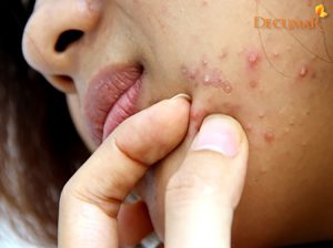 Vì sao bị mụn viêm lâu năm? Điều trị mụn viêm lâu năm thế nào?