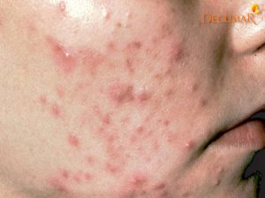9+ Nguyên nhân bị MỤN VIÊM mà không phải ai cũng biết