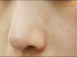 “Vạch trần” 5 sai lầm khiến bạn không thể làm sạch mụn cám triệt để