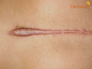 8+ phương pháp trị sẹo thâm và lồi trên da hiệu quả nhất