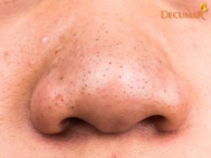 Mụn đầu đen bị viêm do đâu? Phải làm gì khi mụn đầu đen bị viêm?
