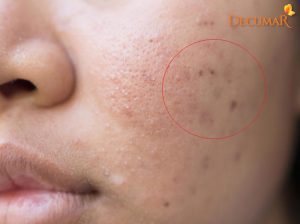 4 cách trị sẹo thâm siêu tốc giúp bạn lấy lại làn da trắng sáng