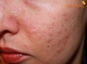 Mụn viêm như thế nào? Đây là tất cả những gì bạn cần biết!