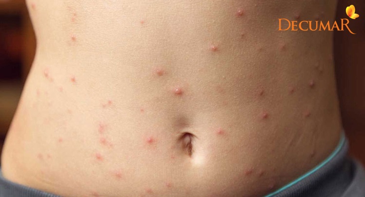 Bị viêm da nổi mụn nước ngứa do nhiều nguyên nhân