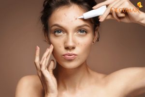 Làm thế nào để chọn được gel trị mụn và vết thâm tốt nhất cho da