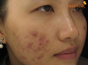 Cách trị mụn thâm ở mặt từ thiên nhiên cho từng loại da