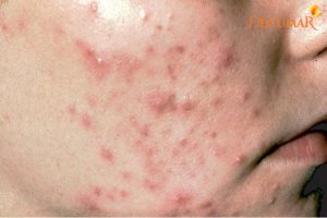 Nguyên nhân nào dẫn tới mụn viêm ở má? Cách điều trị triệt để nhất
