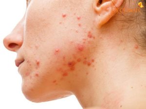 Trị mụn an toàn tại nhà với 7 nguyên liệu tự nhiên dễ tìm