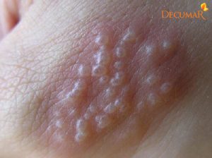 Viêm da nổi mụn nước do đâu? Điều trị như thế nào?