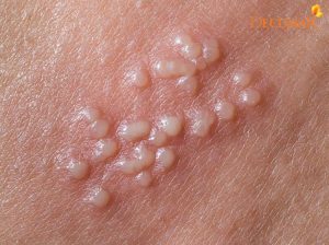 Bỏ túi 9 bước giúp bạn hết mụn nước VIÊM DA TIẾP XÚC