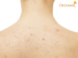 TẮM LÁ có hết MỤN LƯNG VIÊM nang lông không?