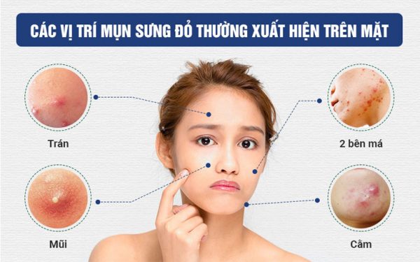 Các vị trí mụn trứng cá thường xuất hiện