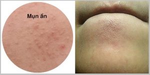 Mụn ẩn dưới cằm là gì ? Nguyên nhân, dấu hiệu và cách điều trị