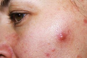 Mụn bọc là gì ? Nguyên nhân và Cách chữa trị mụn bọc hiệu quả