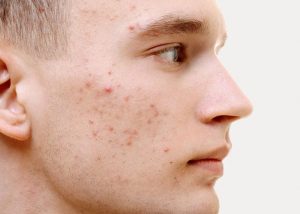 Mụn trứng cá | Nguyên nhân,dấu hiệu và cách điều trị hiệu quả tại nhà