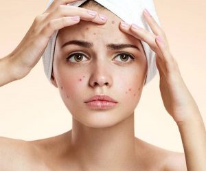 Mụn ẩn là gì ? Bật mí Nguyên nhân và Cách điều trị mụn ẩn tại nhà