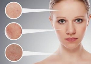 Mụn cám là gì ? Nguyên nhân và cách điều trị mụn cám hiệu quả