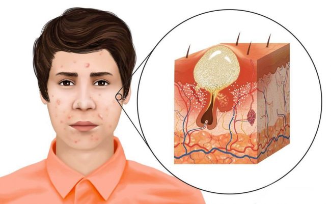Nguyên nhân gây mụn bọc