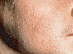Nguyên nhân gây mụn ẩn dưới da và cách phòng tránh hiệu quả