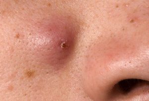 Mụn trứng cá ung: Nguyên nhân, điều trị và ngăn ngừa hiệu quả