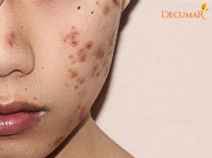 Trị mụn cấp tốc trong 3 ngày – Có thể không?