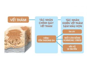 Nguyên tắc khi điều trị thâm mụn mùa lạnh