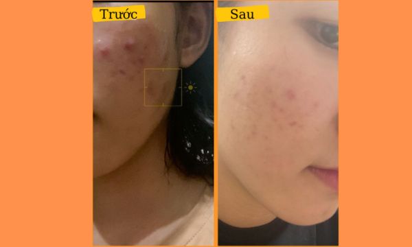 Làn da của Kim Anh đã được cải thiện rõ rệt sau khi sử dụng trọn bộ chăm sóc da mụn Decumar